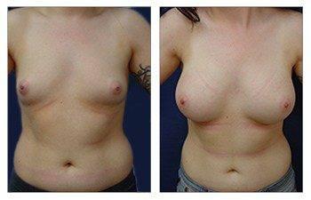 Breast Augmentation Fat Transfer, CPSI, width: 350px; height: 225px; Breast Augmentation Fat Transfer, CPSI, width: 350px; height: 225px;
