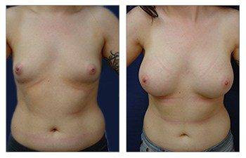 Breast Augmentation — #SS200 Breast Augmentation — #SS200
