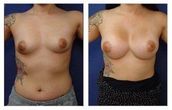 Natural Breast Augmentation (NBA) Natural Breast Augmentation (NBA)