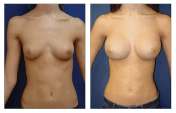 Breast Augmentation Recovery Breast Augmentation Recovery