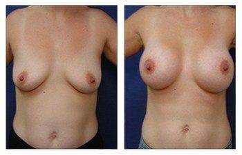 Types of Breast Augmentation Surgery, CPSI, width: 350px; height: 225px; Types of Breast Augmentation Surgery, CPSI, width: 350px; height: 225px;