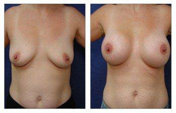 Breast Augmentation — #SS202 Breast Augmentation — #SS202