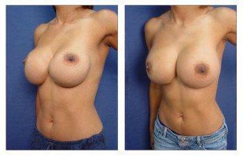 Breast Augmentation Revision Breast Augmentation Revision