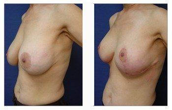 breast lift and augmentation patient 19 front left view breast lift and augmentation patient 19 front left view