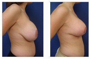 breast augmentation revision patient 16 right view breast augmentation revision patient 16 right view