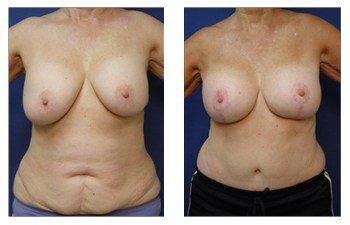 breast augmentation revision patient 1 front view breast augmentation revision patient 1 front view