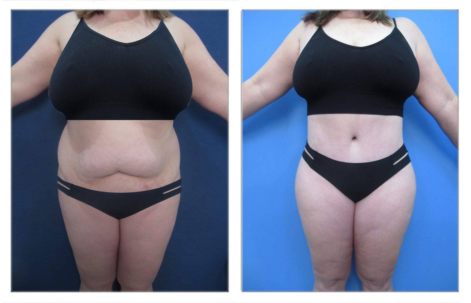 How Does Insulin Resistance Affect Cosmetic Surgery of the Abdomen How Does Insulin Resistance Affect Cosmetic Surgery of the Abdomen