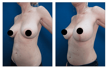 What is a Breast Lift with Implants Over the Muscle? What is a Breast Lift with Implants Over the Muscle?