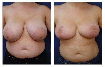 When Do Breast Lift Scars Fade, CPSI, width: 350px; height: 225px; When Do Breast Lift Scars Fade, CPSI, width: 350px; height: 225px;