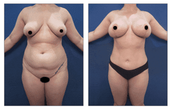 Tummy tuck and HD Liposuction before and after. Tummy tuck and HD Liposuction before and after.