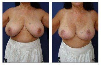 When Do Breast Lift Scars Fade, CPSI, width: 350px; height: 225px; When Do Breast Lift Scars Fade, CPSI, width: 350px; height: 225px;