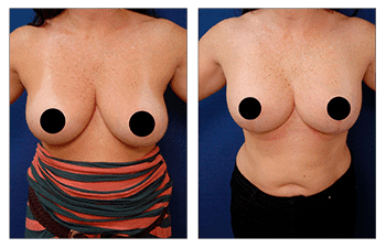 A woman's breasts before and after breast lift surgery. A woman's breasts before and after breast lift surgery.