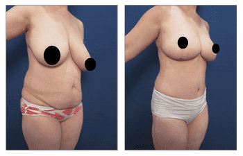 A woman's breasts before and after HD Liposuction surgery. A woman's breasts before and after HD Liposuction surgery.