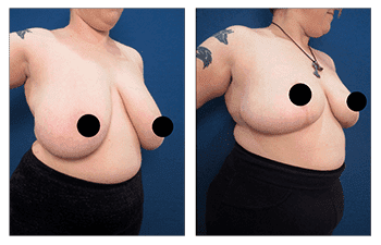 Before and after pictures of a woman's breast surgery showcasing the transformative results of breast reduction. Before and after pictures of a woman's breast surgery showcasing the transformative results of breast reduction.