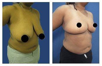 Best Breast Reduction Best Breast Reduction