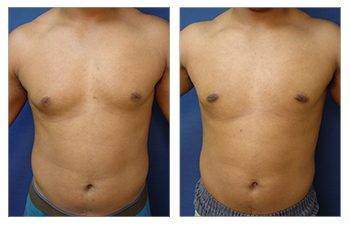 Combining tummy tuck and Lipo for before and after transformations. Combining tummy tuck and Lipo for before and after transformations.