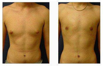 Gynecomastia — #SS210 Gynecomastia — #SS210