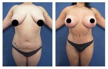 Mommy Makeover for Plus Sized Clients Mommy Makeover for Plus Sized Clients