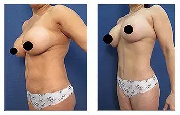 A woman's breast before and after a Mommy Makeover surgery to fix contour irregularities. A woman's breast before and after a Mommy Makeover surgery to fix contour irregularities.