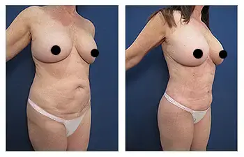 Before and after a Mommy Makeover surgery, a woman's breast undergoes significant transformation. Before and after a Mommy Makeover surgery, a woman's breast undergoes significant transformation.