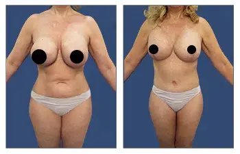 Mommy Makeover To Eliminate Flank Fullness Mommy Makeover To Eliminate Flank Fullness