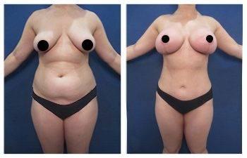 Mommy Makeover – Upper Belly Fullness Mommy Makeover – Upper Belly Fullness