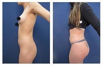Butt Implant Cost Los Angeles, CA Butt Implant Cost Los Angeles, CA