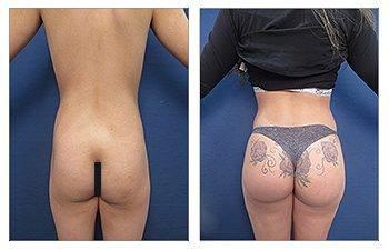 Butt Implant Cost LA, CA Butt Implant Cost LA, CA