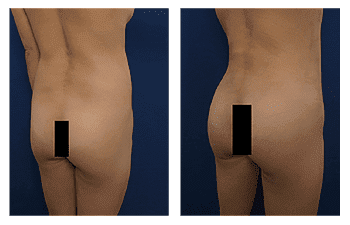 Buttock Augmentation Recovery Time Buttock Augmentation Recovery Time