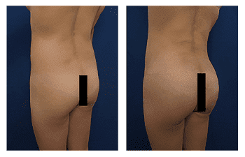 Buttock Augmentation Recovery Time Buttock Augmentation Recovery Time