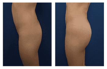 Buttock Augmentation Recovery Time