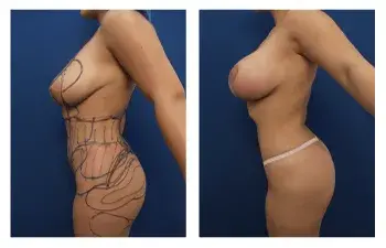 Buttock Augmentation Risks Buttock Augmentation Risks
