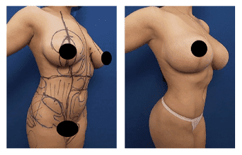 HD Liposuction + Fat Transfer — #SS037 HD Liposuction + Fat Transfer — #SS037