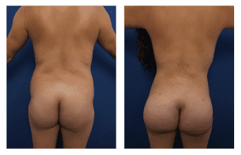 Buttock Implant Risks Buttock Implant Risks