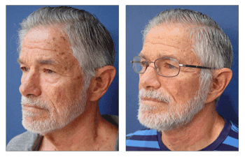 A man with a beard and glasses before and after a successful facelift.