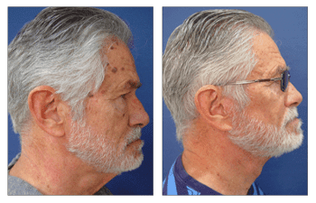 A man with gray hair before and after a facelift, showcasing the transformative results.