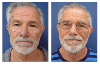 A man with a beard and glasses before and after a facelift. Can a facelift go wrong?