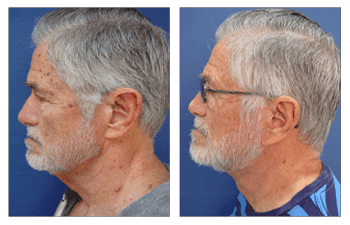 Before and after photos showcasing a man's facelift transformation.