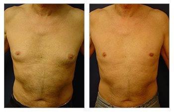 gynecomastia surgery be covered by insurance gynecomastia surgery be covered by insurance