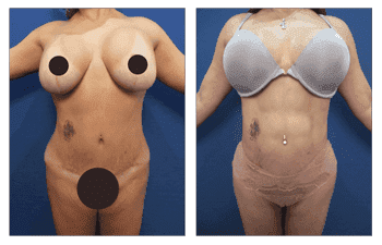 Can I Perform Abdominal Etching With Mini Tummy Tuck Can I Perform Abdominal Etching With Mini Tummy Tuck