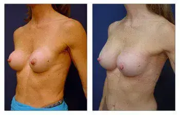 A woman's breast, exhibiting capsular contracture and/or asymmetry, is observed before and after surgery. A woman's breast, exhibiting capsular contracture and/or asymmetry, is observed before and after surgery.