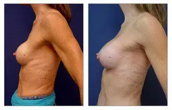 A woman's breast before and after surgery, showing changes due to capsular contracture and/or asymmetry.