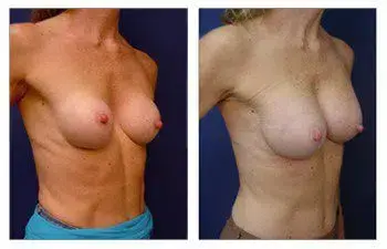 A woman's breast, showing changes before and after surgery for capsular contracture and asymmetry. A woman's breast, showing changes before and after surgery for capsular contracture and asymmetry.