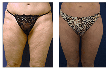 Tummy tuck and HD Liposuction before and after. Tummy tuck and HD Liposuction before and after.