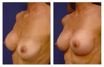 Correction of implant deflation to enhance breast augmentation before and after. Correction of implant deflation to enhance breast augmentation before and after.