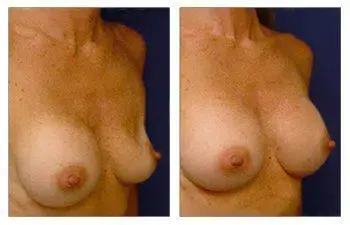 A woman's breast before and after breast augmentation showing correction of implant deflation. A woman's breast before and after breast augmentation showing correction of implant deflation.