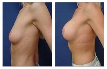 Breast Augmentation — #SS198