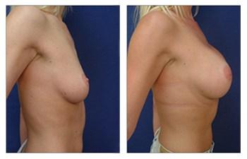 Breast Augmentation — #SS198
