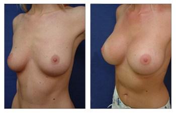 Breast Augmentation — #SS198