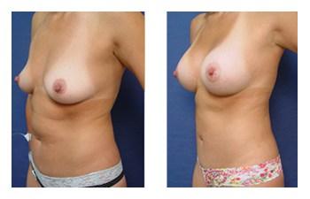 Breast Augmentation — #SS197